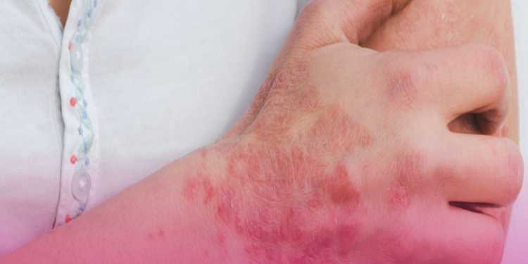 Hanseníase: Brasil registrou mais de 300 mil casos da doença em dez anos