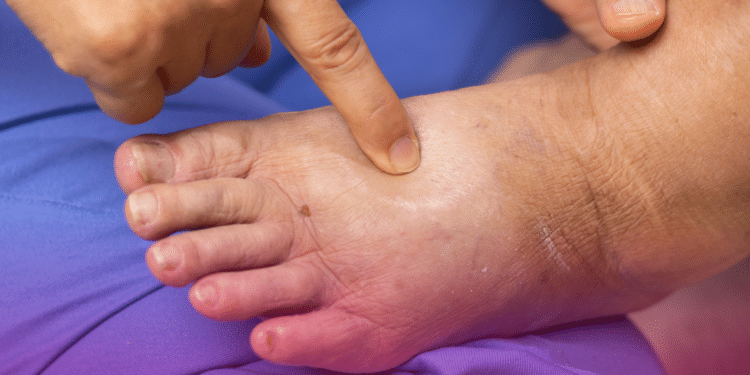 Calor intensifica inchaço nas pernas e problemas circulatórios