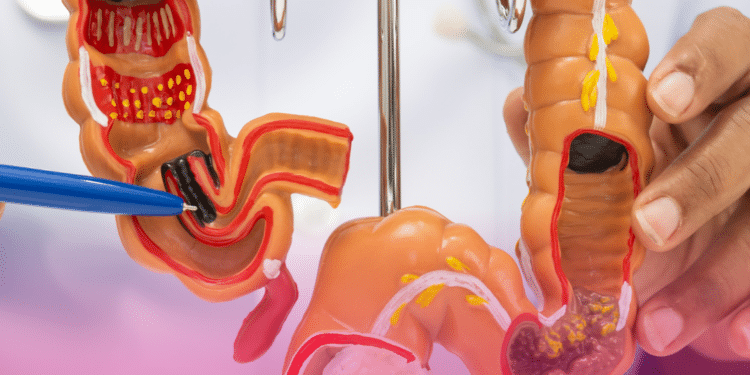 Câncer colorretal cresce 7,6% ao ano entre adultos jovens no Brasil, aponta A.C.Camargo