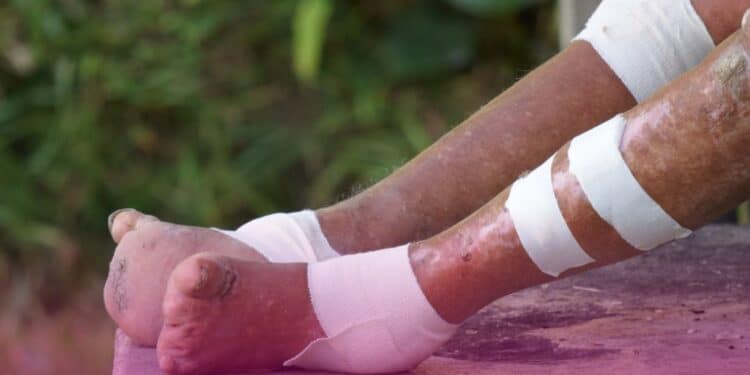 Conitec abre novas consultas públicas sobre tratamentos para leishmaniose, hanseníase, Parkinson e leiomioma de útero no SUS