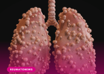 Tuberculose: pacientes com doenças reumáticas têm risco até 10 vezes maior