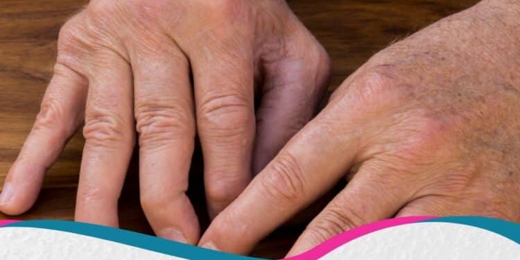 EULAR 2026: Inovações para Melhorar os Desfechos na Artrite Psoriásica