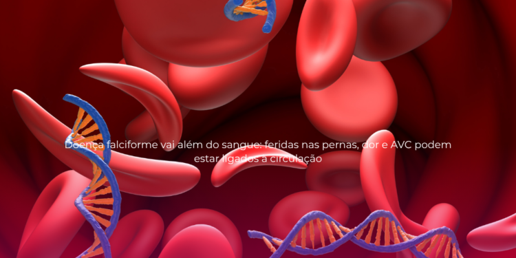 Doença falciforme vai além do sangue: feridas nas pernas, dor e AVC podem estar ligados à circulação