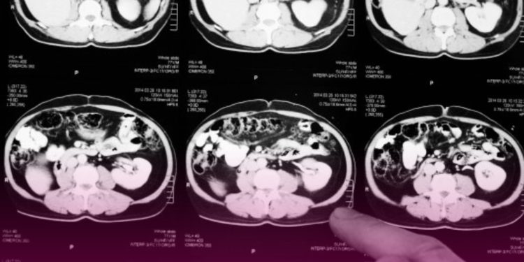 Anvisa aprova novo medicamento para câncer colorretal metastático
