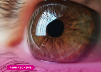 Uso indiscriminado de corticoides pode causar glaucoma e cegueira