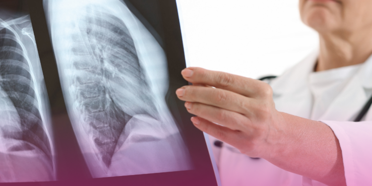 ANS aprova exame para diagnóstico de doenças pulmonares