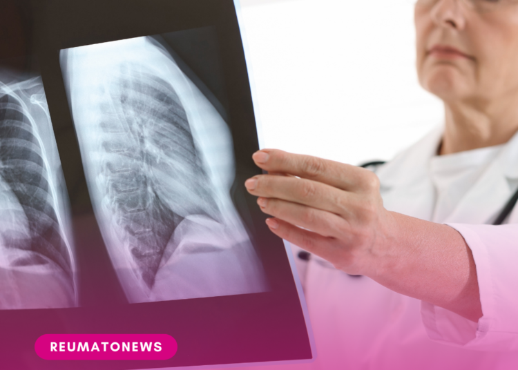 ANS aprova exame para diagnóstico de doenças pulmonares