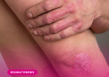 Dia Mundial da Psoríase: dermatologista da SBCD explica como reconhecer a doença e quais cuidados adotar